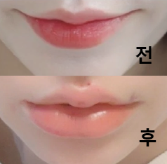 꼼꼼하게 원하는 부위 다 맞춤으로 시술 해 주셨어요!