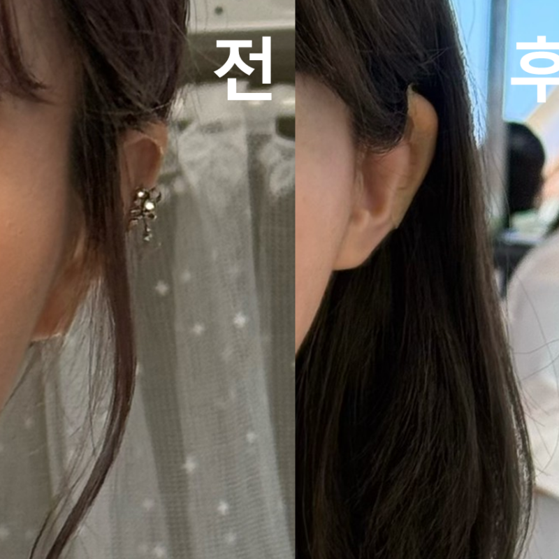 귀필러 하고왔어요! 얼굴 작아 보이고 좋네요~