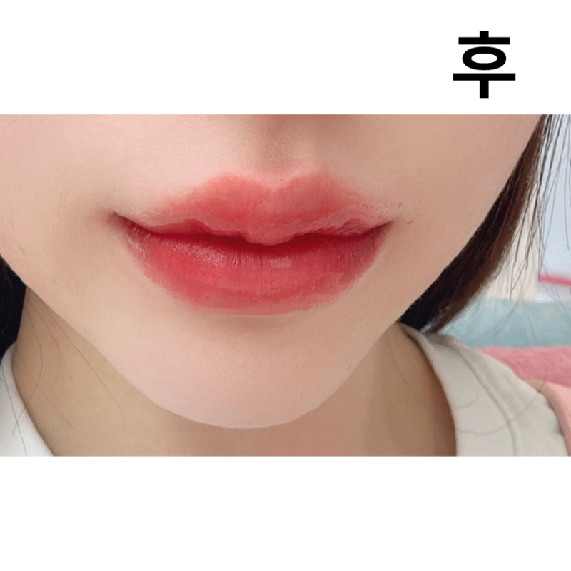 입술필러 쥬비덤으로 받았어요! 대기 시간도 없어서 좋았습니다. 감사합니다~