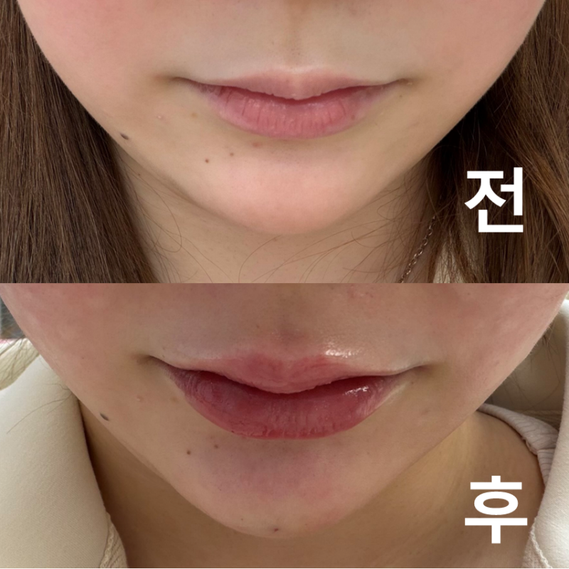 턱 필러 맞고 훨씬 예쁘게 보이게 됐어요~ 꼼꼼한 상담 덕분에 안심하고 받을 수 있고 자연스러운 결과라 너무 만족합니다!