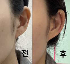 애프터가 확실히 차이 나서 좋았어요!