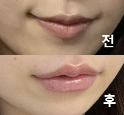 또 한국에 오면 시술 받으러 오고 싶어요!