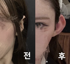 귀필러 처음 맞아봤는데 정말 만족해요!