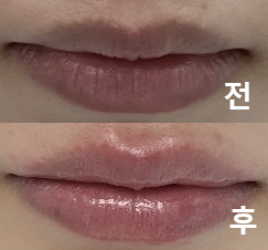 시술 중에도 통증이 없어서 다행이었어요!