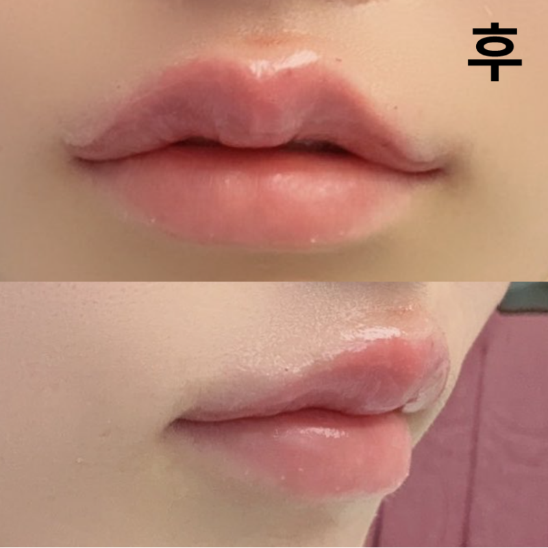 롤리팝에서 입술필러랑 보톡스 맞았어요! C컬이 만들어져서 너무 좋아요~