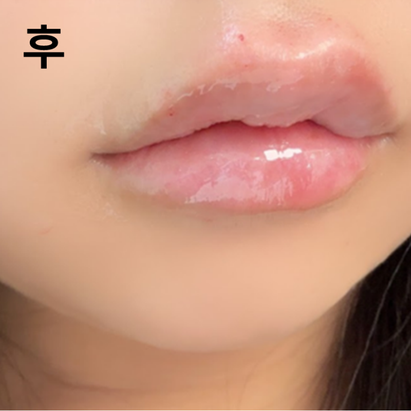 입술필러와 보톡스를 처음 맞아봤습니다. 어떤 시술이 맞는지 가티 고민해주시고 만족입니다!