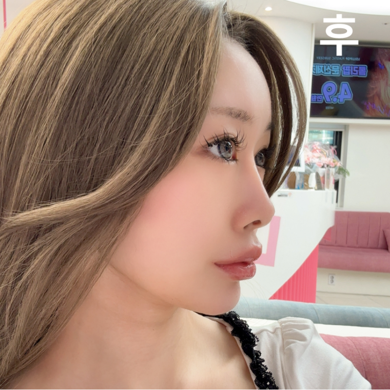 롤리팝에서 볼필러, 턱필러,입술필러, 보톡스를 맞고 왔어요. 마취도 잘되서 그런지 하나도 안아팠어요!
