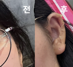 꼼꼼하게 시술해 주시는 게 느껴졌고 결과도 마음에 들어요!