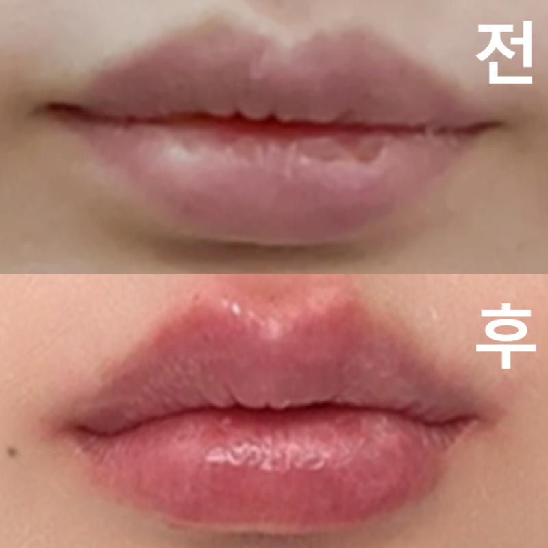 평평한 입술때문에 무뚝뚝해 보이기 싫어서 받았는데 다들 예쁘다고 해요! 시술 시간도 짧고 결과도 매우 만족합니다!
