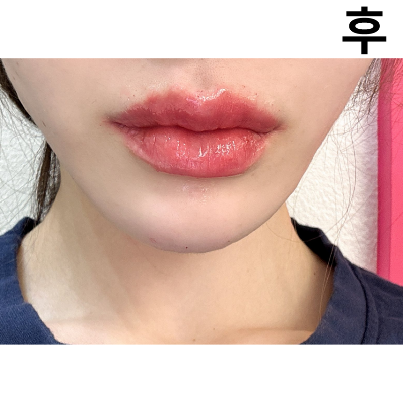 롤리팝에서 입술필러 맞았어요! 이상적인 모양으로 해주셔서 완전 마음에 들어요~