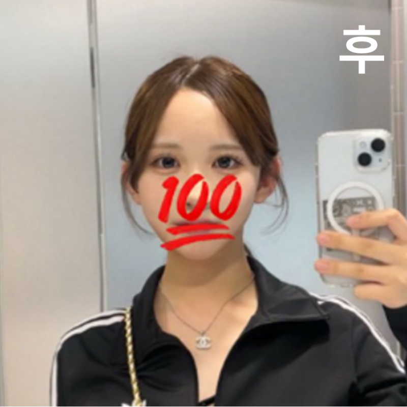 롤리팝에서 입체 귀 필러 하고 왔어요! 시술 전보다 어려 보이고 얼굴도 작아 보여서 완전 만족~