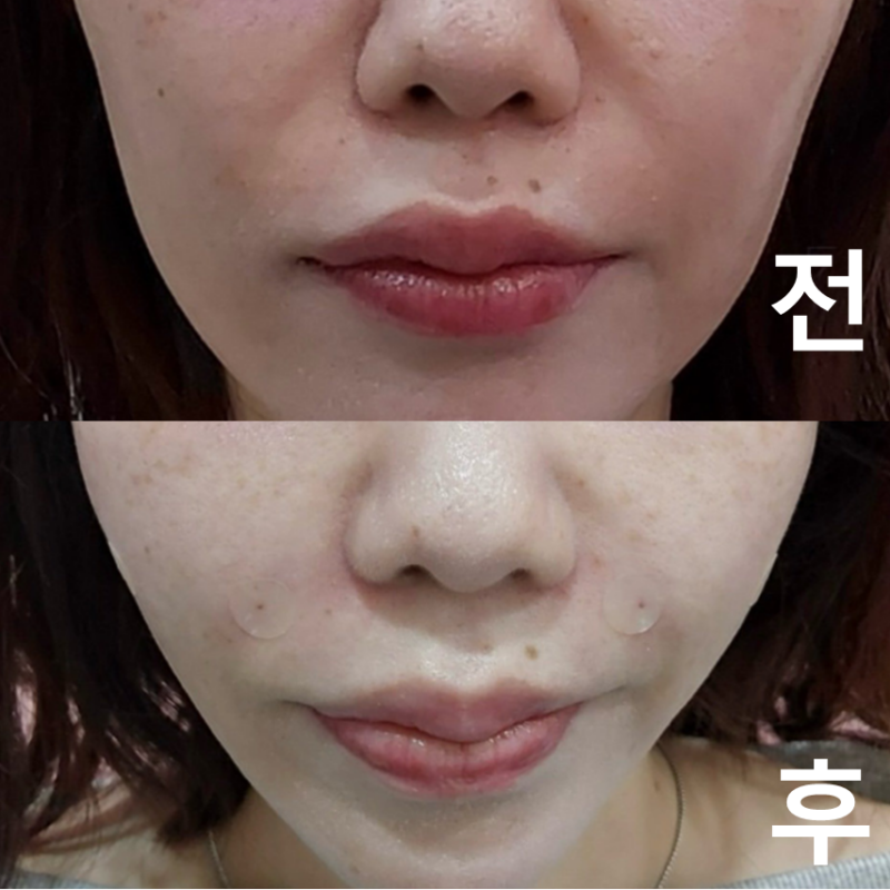 롤리팝에서 볼꺼짐, 팔자 필러 하고 왔어요! 또 올게요~