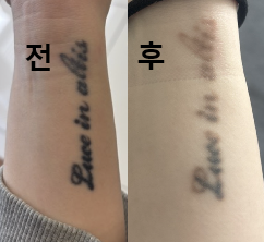 3번째 방문인데 잘 지워지고 있어서 만족해요!