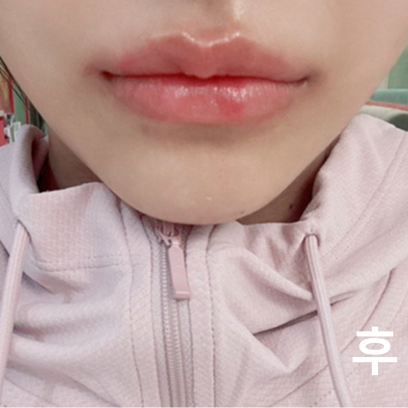 롤리팝에서 입술 필러 맞고 왔어요!
