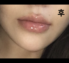 상담도 자세히 해주시고 시술도 꼼꼼하게 해주셨어요!