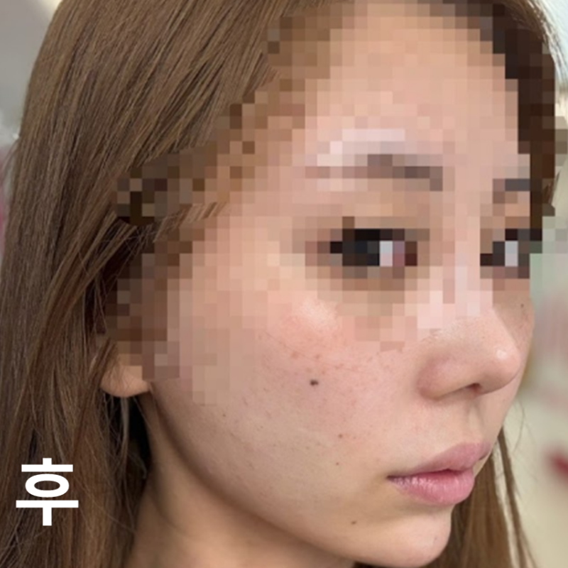 턱, 볼밑 필러 맞았어요! 필요한 것과 필요하지 않은 것을 확실히 알려주시고 결과도 만족하니다~