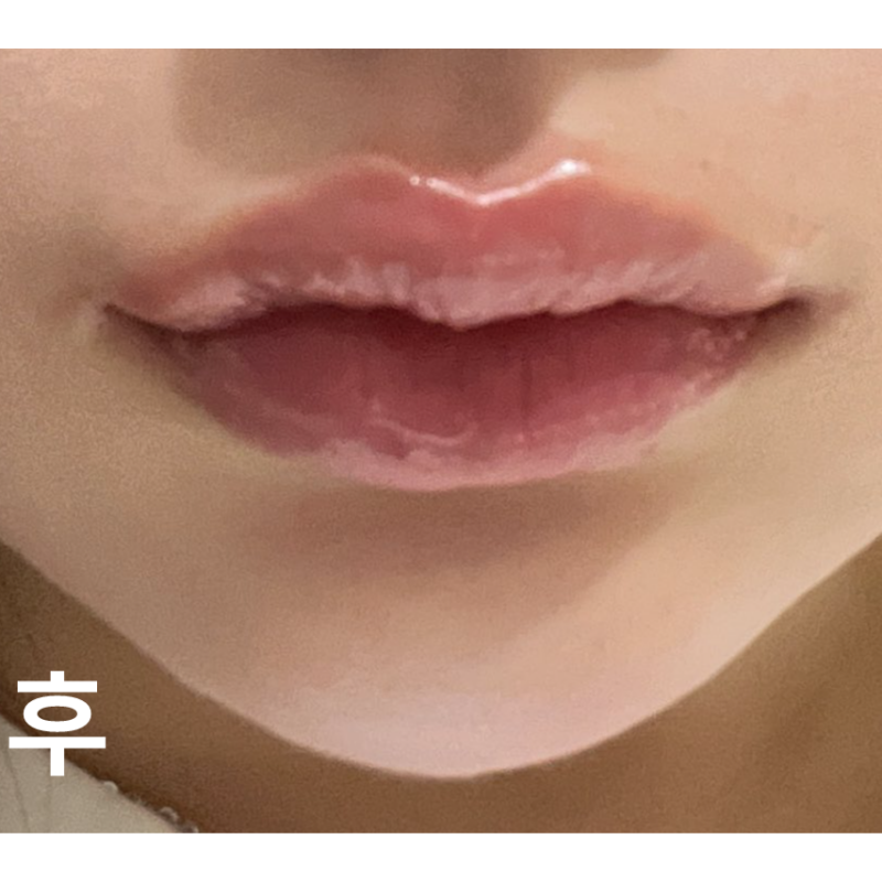 롤리팝에서 맞은 입술 필러 대만족이에요~! 실장님도 꼼꼼하고 친절해서 좋았어요!