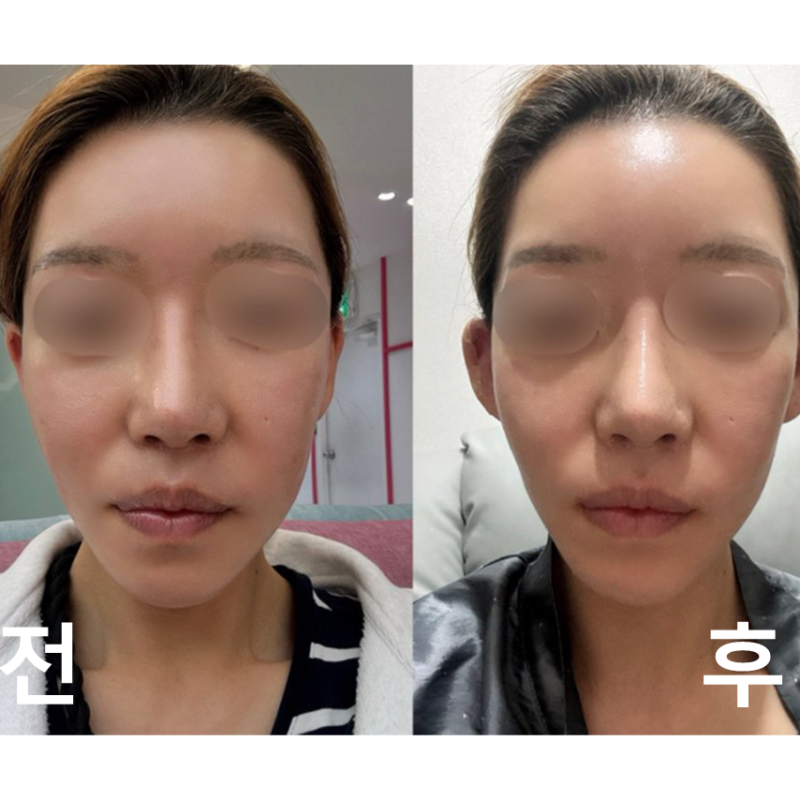 귀필러 맞고 왔는데 진짜 얼굴이 달라져 보여요! 통증도 없었고 대만족입니다.