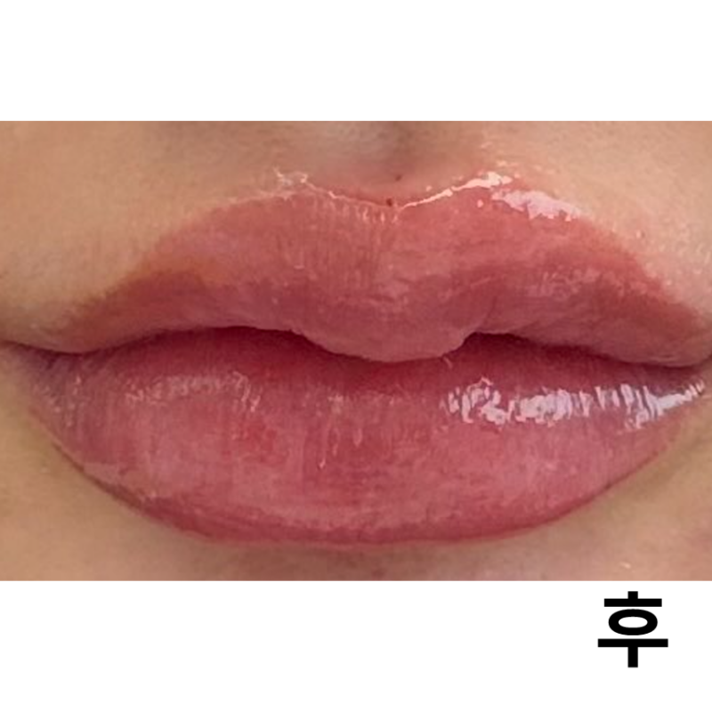 입술 필러는 항상 롤리팝에서 맞고 있어요!