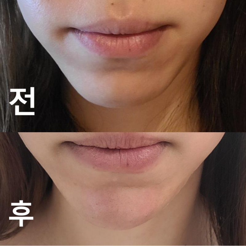 턱필러 맞았어요! 원래 턱이 작은 편이라 조금 앞에 빼달라고 부탁드렸어요!