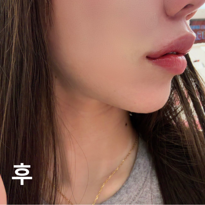 롤리팝 2번째 방문입니다! 팔짜 필러, 입꼬리 필러해서 너무 마음에 들어요~!