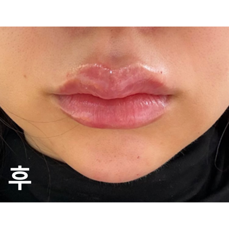 상담도 꼼꼼하게 해주시고 시술도 빨리 해주셔서 좋았습니다!