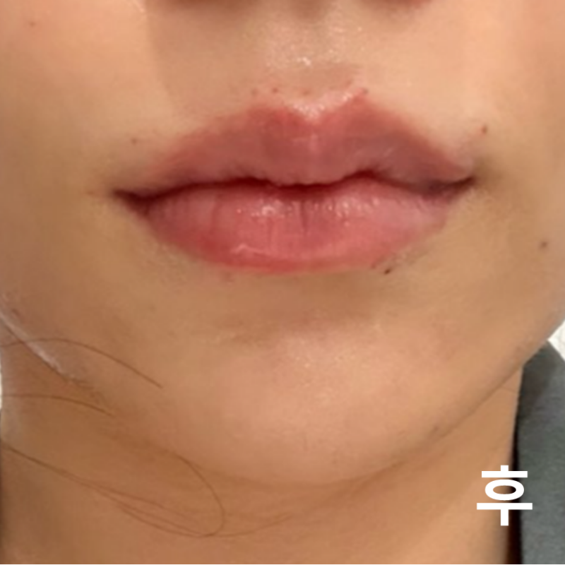 정말 꼼꼼하게 잘해주셔서 너무 좋었고 입술필러도 엄청 마음에 들어요! 꼭 다시 올게용