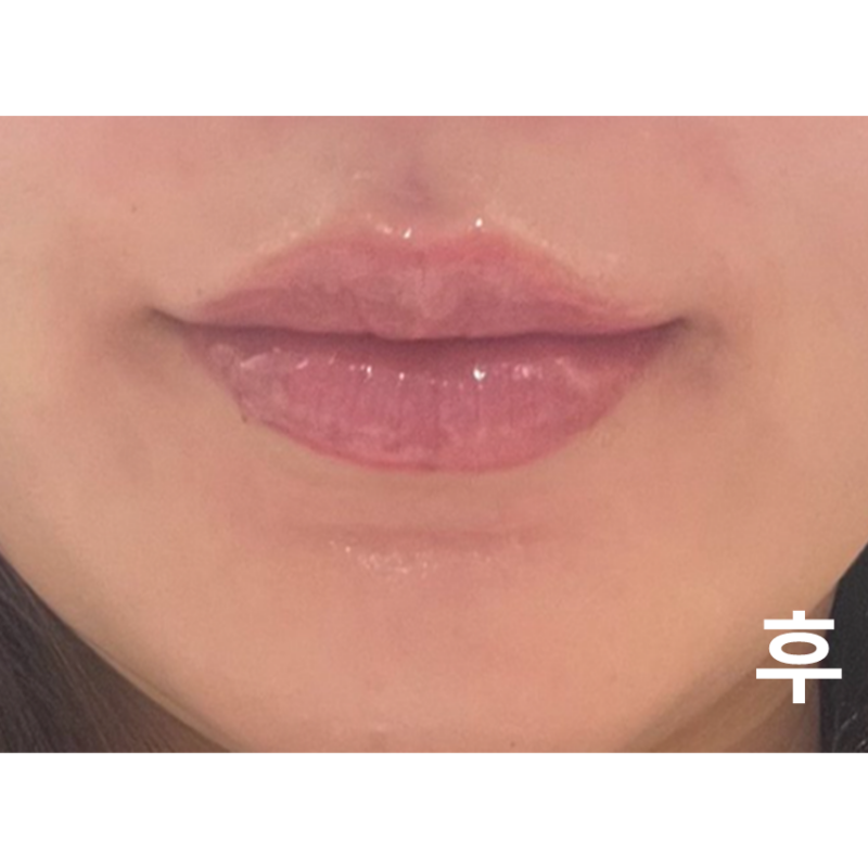 입술필러 맞고 왔어요! 통증도 없고 최고~