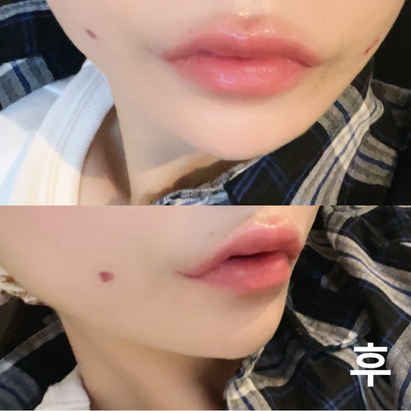 롤리팝에서 입술필러, 보톡스 맞고 왔어요!