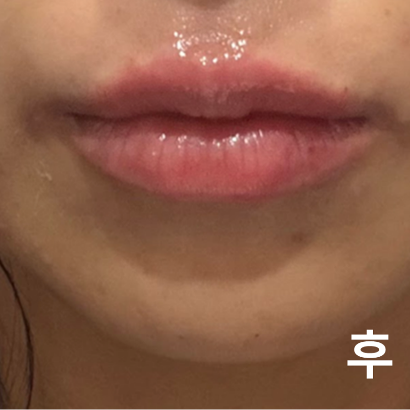 입술필러 맞고 왔습니다! 상담도 꼼꼼하게 해주시고 만족합니다!