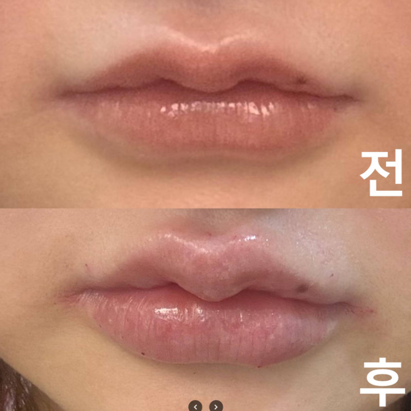 3년 동안 다니고 있는 클리닉입니다! 조금 아프지만 일본어 통역사분들이 계셔서 안심합니다! 일본인에게 추천!
