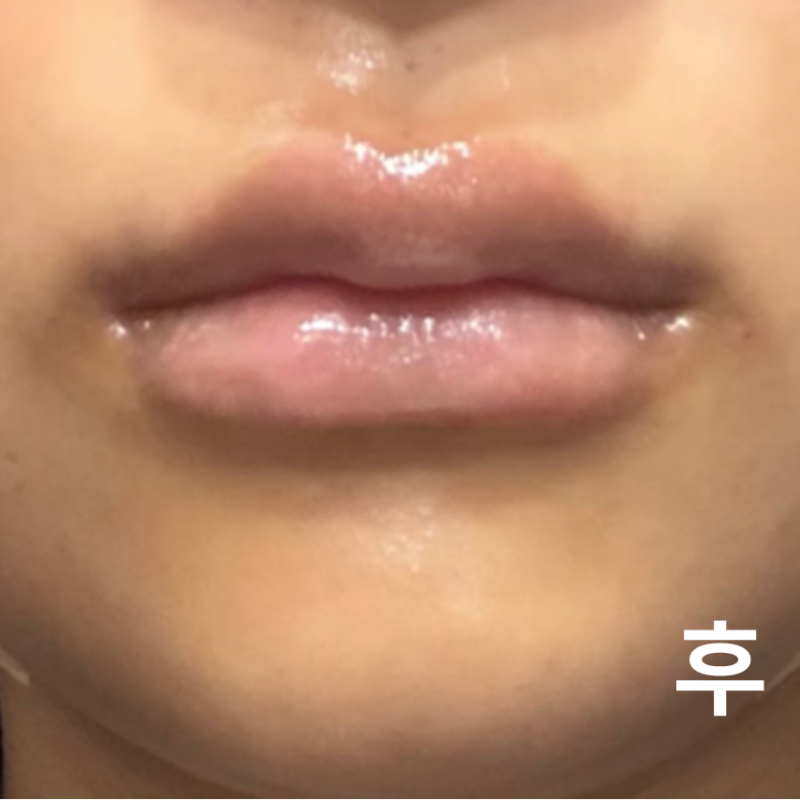 포키주사랑 필러를 맞았습니다. 실장님이 상담 질 해주시고 시술도 꼼꼼하게 해주셔서 재방문하려고요!
