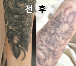 너무 친절하셔서 긴장도 풀리고 생각보다 빠른 시술에 만족스러워요!