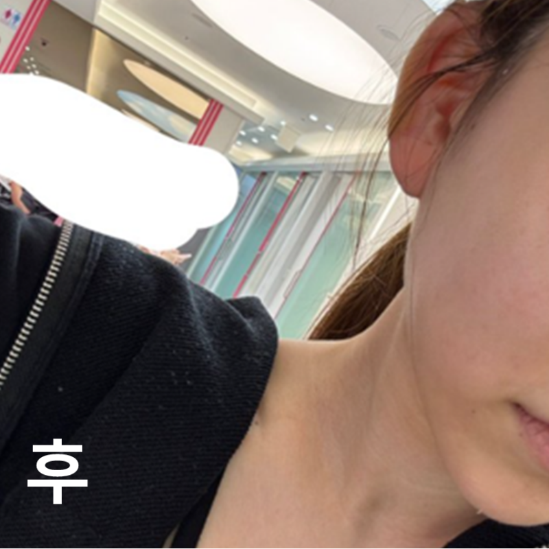 귀필러는 아프다고 들었는데 전혀 안 아팠어요!