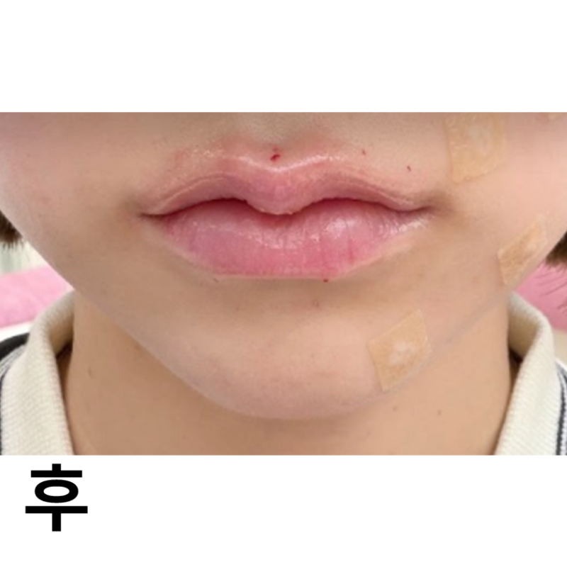 입술이 작은게 고민이라서 필러 맞고 왔습니다. 시술 직후에 바로 예뻐져서 대만족입니다!