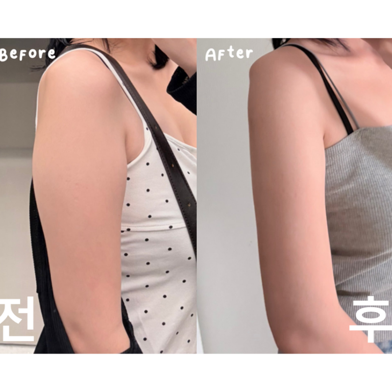 팔뚝 포키주가와 보톡스를 같이 맞았는데 효과가 좋아요! 다음에는 다른 부위도 받아보고 싶어요~