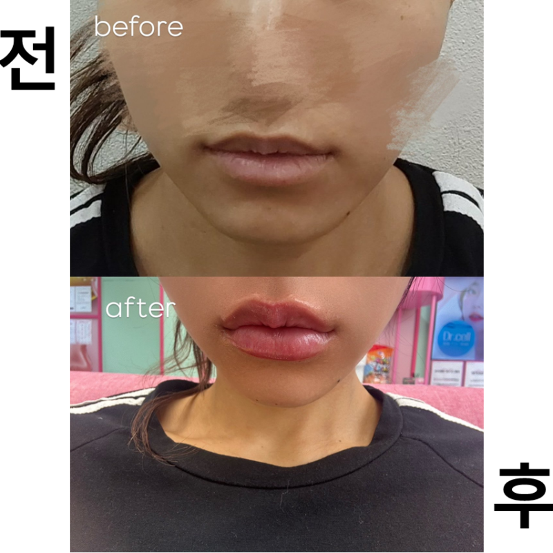 입술필러 받았어요! 너무 무서웠는데 직원분들이 너무 친절하서 결과도 대만족입니다!