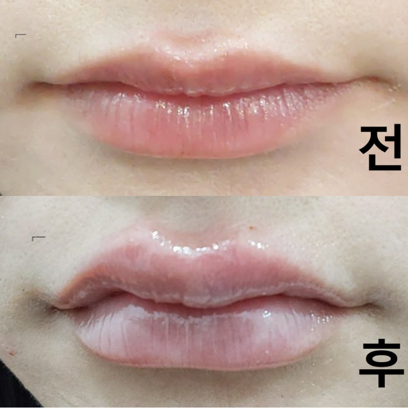 처진 입꼬리를 개선하고 싶어서 시술을 받았습니다. 설명도 친절하고 꼼꼼해서 좋았어요! 대만족입니다~
