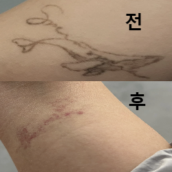 3회 만으로 다 지워졌어요!