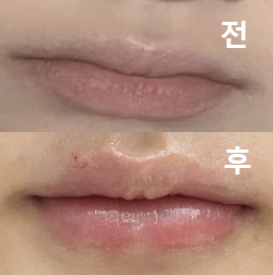 원하는 모양으로 잘 시술 받았어요!