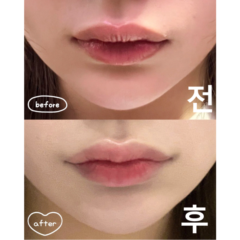 롤리팝에서 입술필러 받은 지 2주 됬어요! 자연스럽게 예뻐졌고 너무 만족합니다~