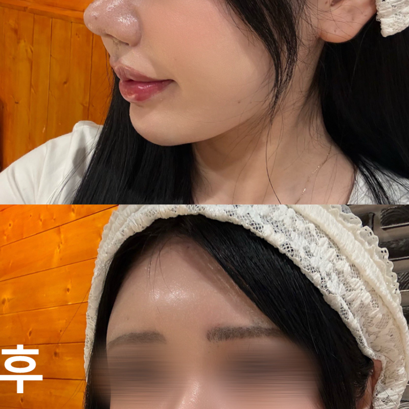 롤리팝에서 필러 맞고 왔어요! 결과는 정말 대만족입니다!