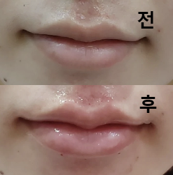 상담도 시술도 꼼꼼하게 진행되었어요!