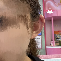 시술 후 통증도 거의 없었어요!