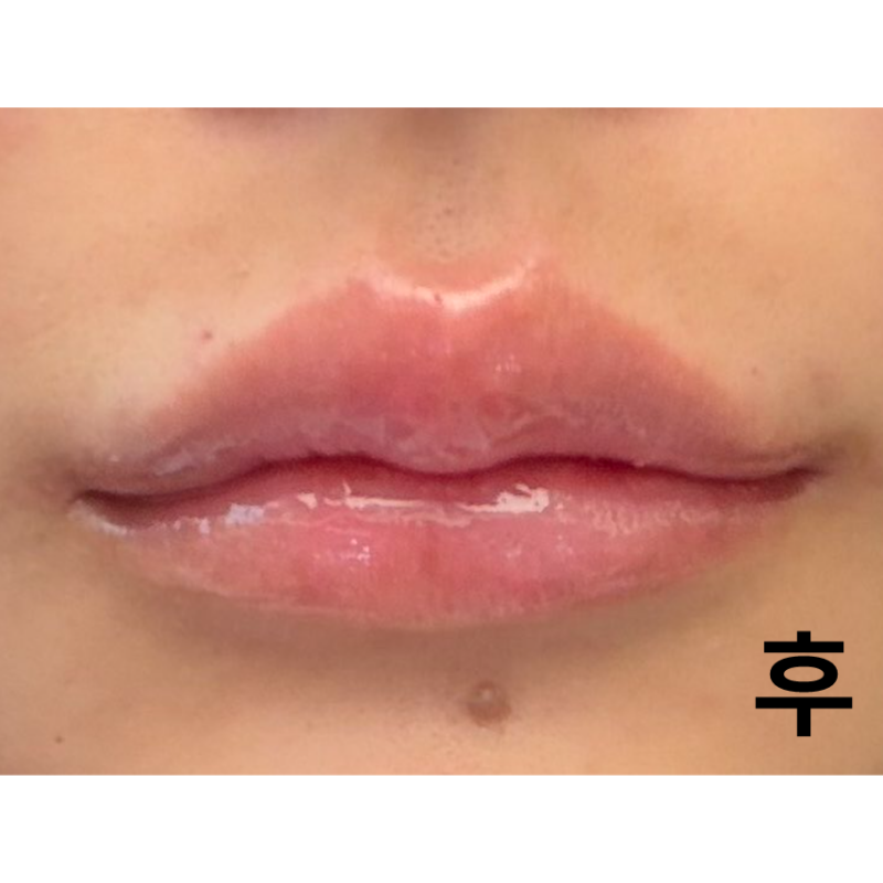 　롤리팝에서 입술필러 맞고 왔어요! 너무 예쁘게 잘 돼서 정말 만족해요~