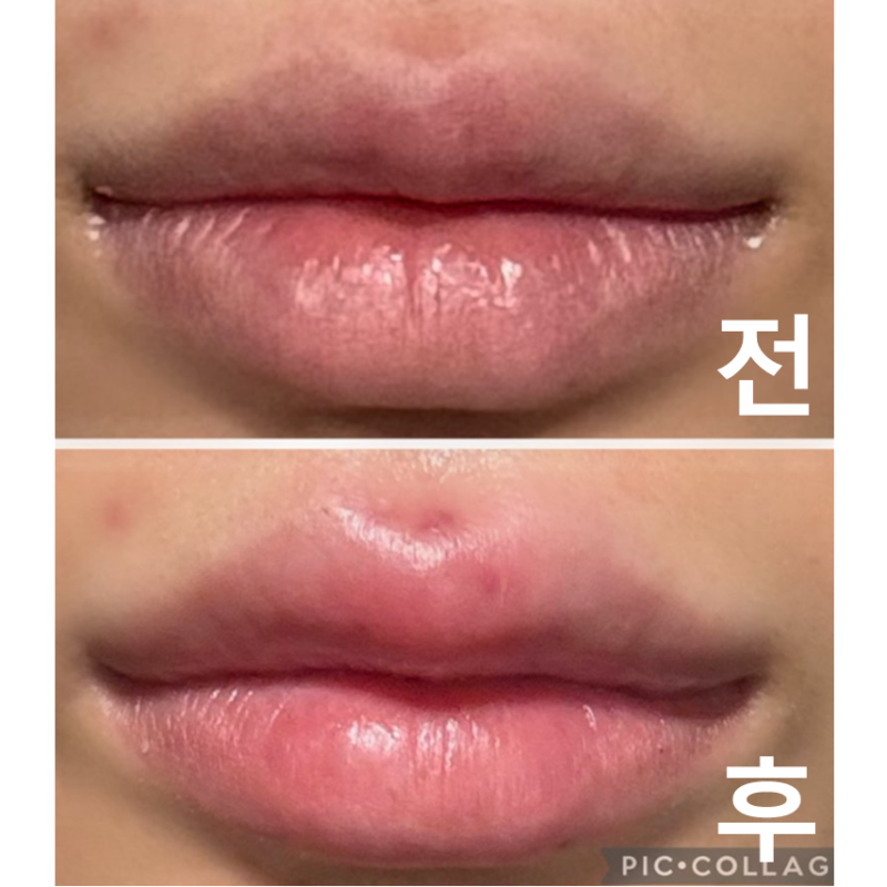롤리팝에서 입수릴러 맞고 왔어요! 매번 대만족입니다~