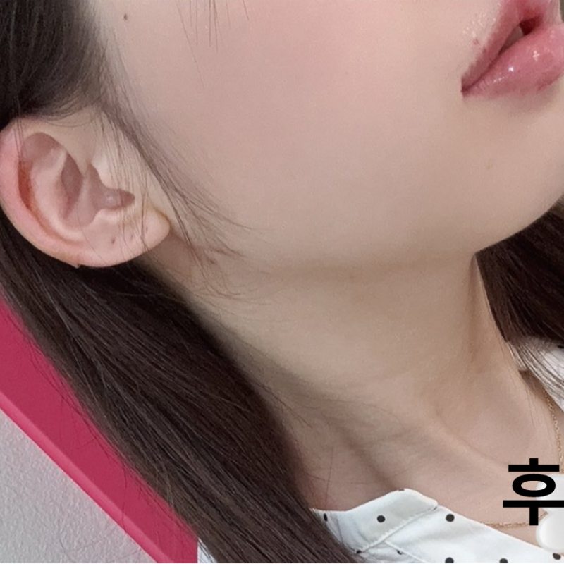 롤리팝에서 입술이랑 귀필러 맞고 왔어요! 정말 만족스러워요~