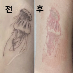1회차 만에 효과가 너무 좋아서 계속 하려구요!