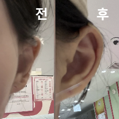 효과도 즉각적으로 나타나서 좋았고 일상생활도 바로 가능했어요!