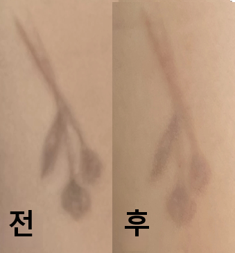 물집 없이 잘 지워지고 있어요! 감사합니다